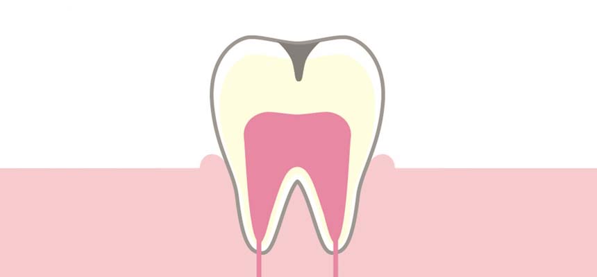 C2：象牙質に達したう蝕