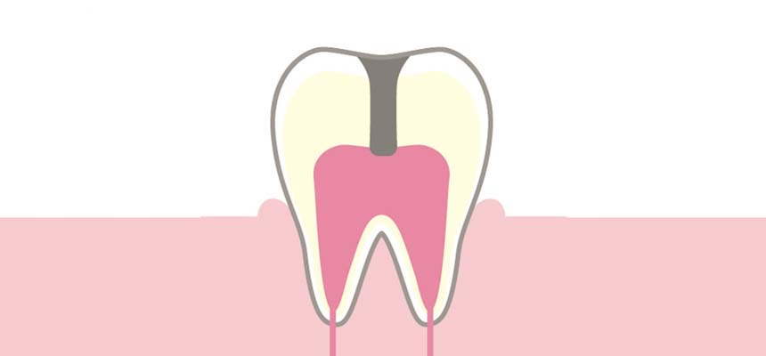 C3：歯髄(神経)に達したう蝕