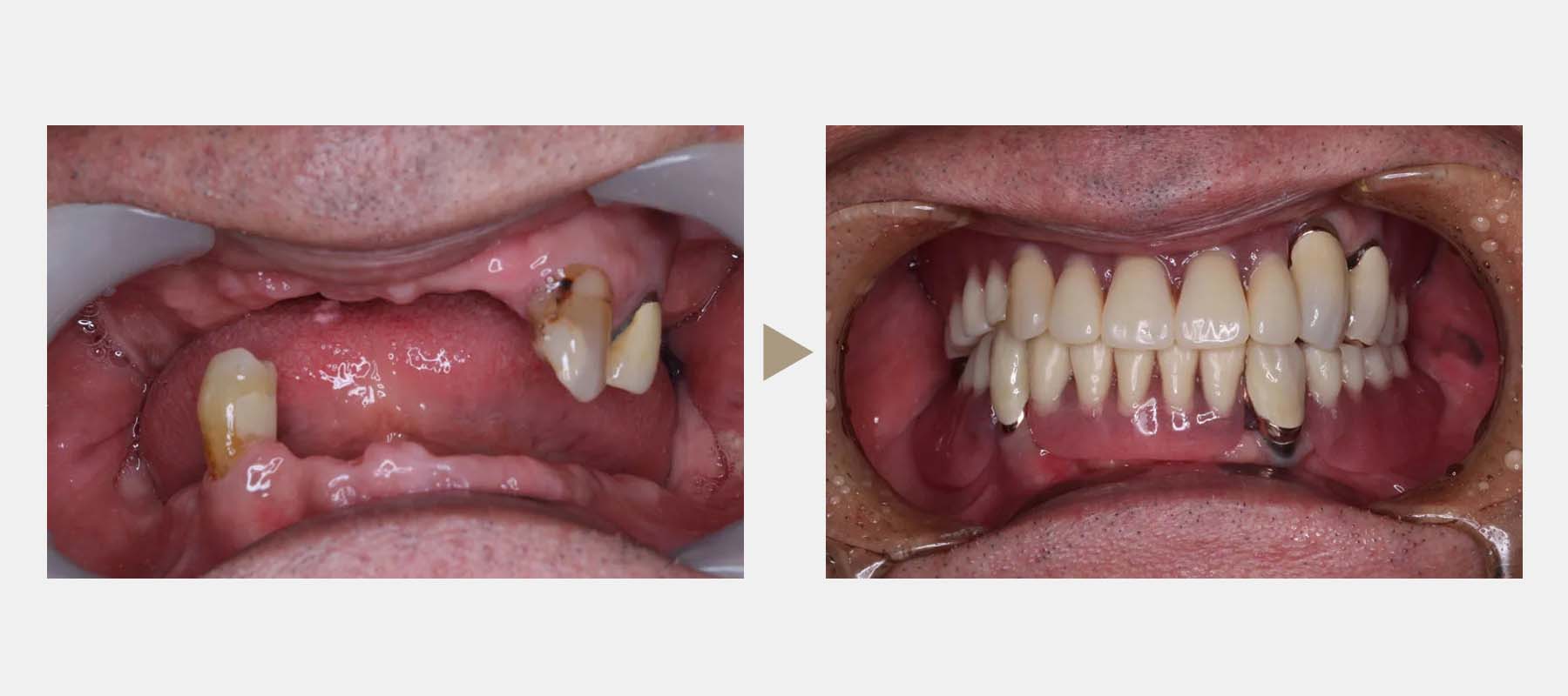 コーヌス義歯の症例紹介1