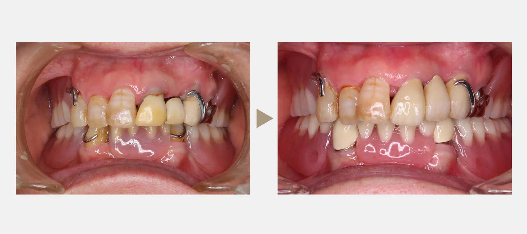 コーヌス義歯の症例紹介2