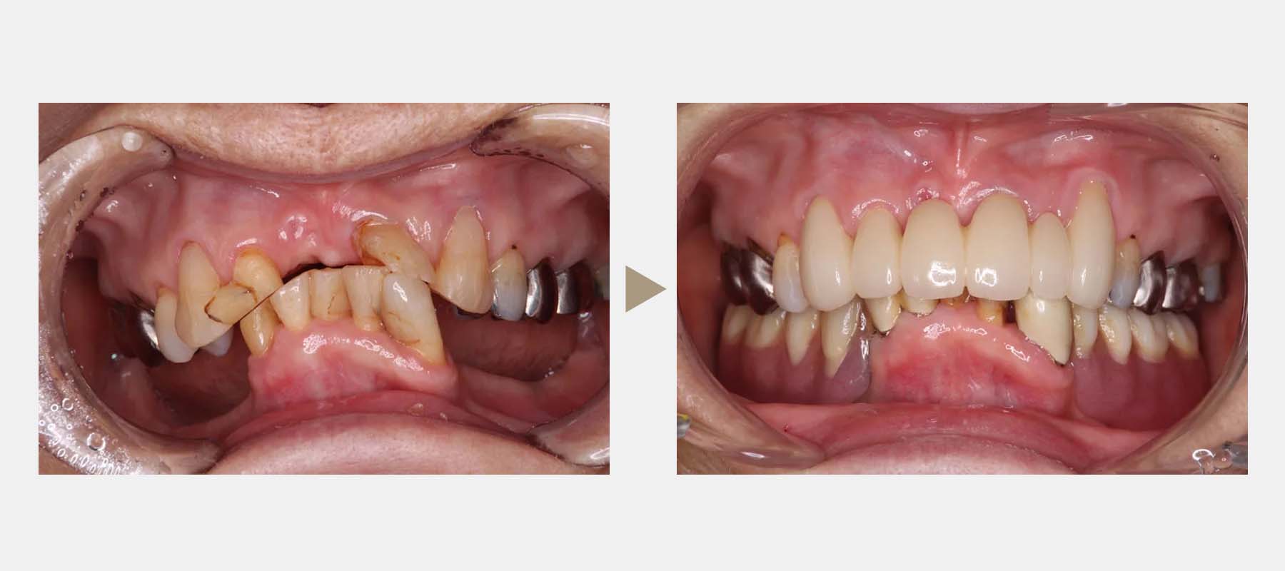 コーヌス義歯の症例紹介3