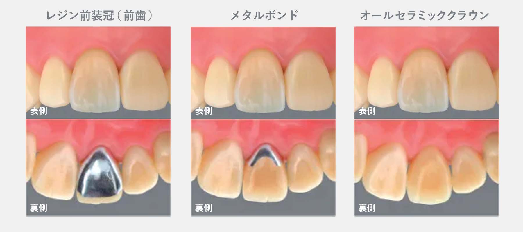 クラウン（被せ物）のそれぞれの素材特徴