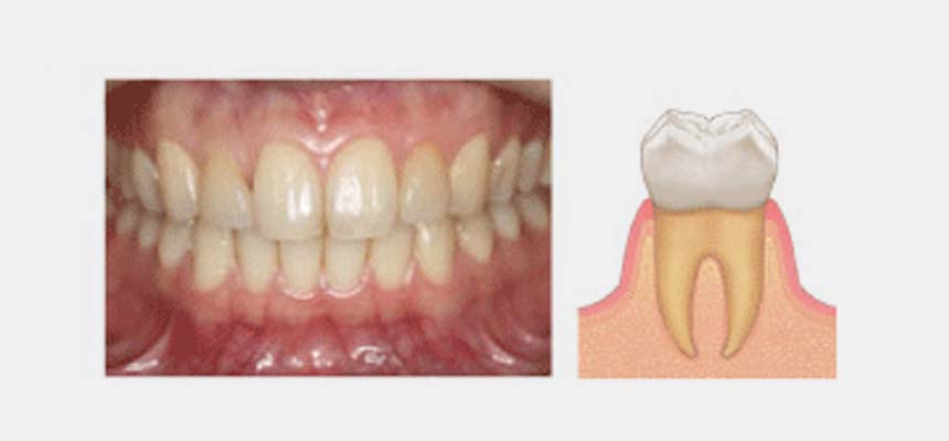 健康な歯周組織