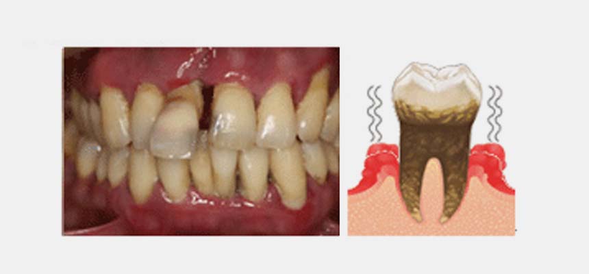 重度歯周炎