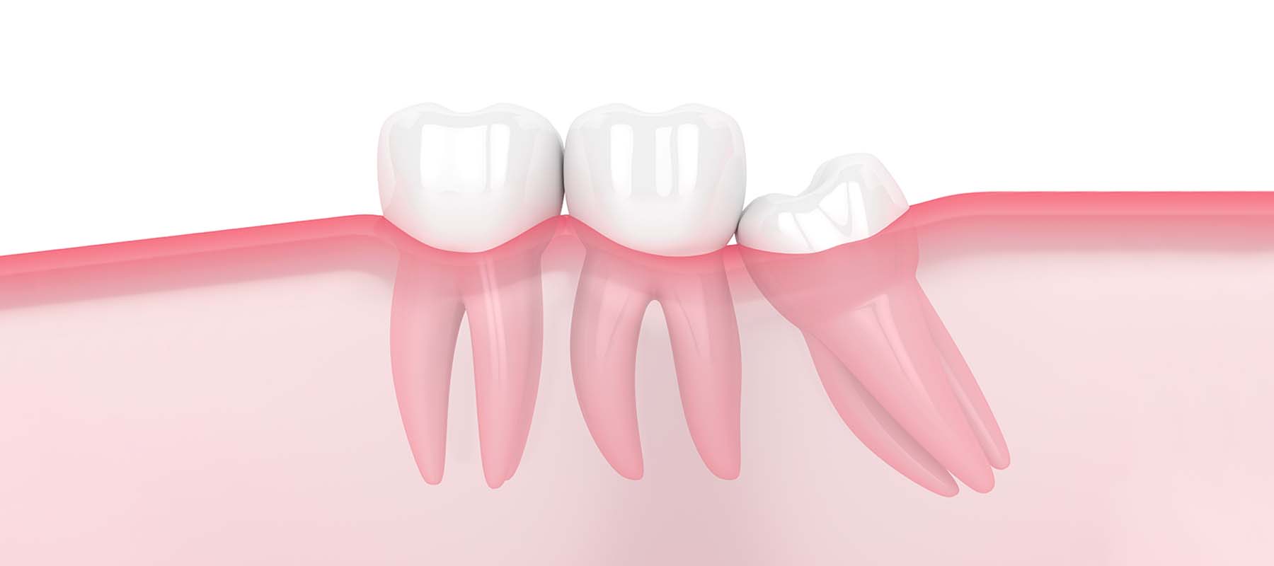 口腔外科学会認定医による親知らずの抜歯