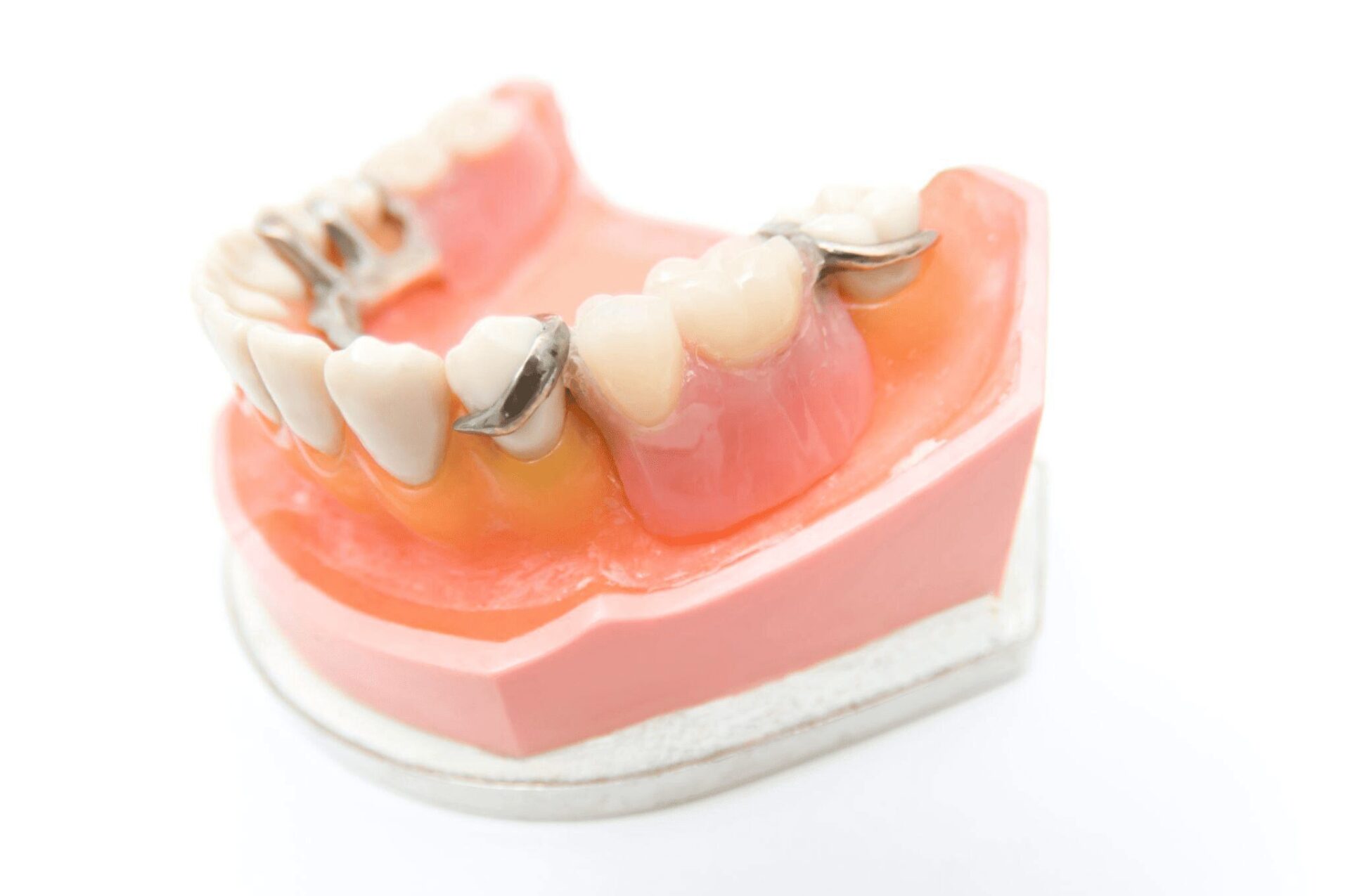 若い人が部分入れ歯を検討するときのよくある悩み