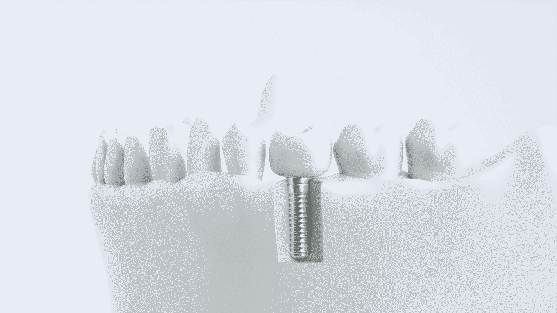 入れ歯の代わりになる治療法の選び方